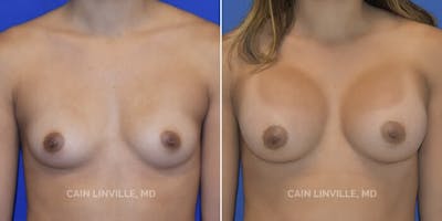 Breast Augmentation Before & After Gallery - Patient 8523014 - Image 1