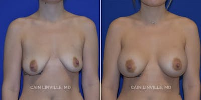 Breast Augmentation Before & After Gallery - Patient 8523027 - Image 1