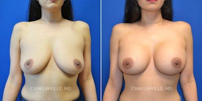 Breast Augmentation Before & After Gallery - Patient 8523043 - Image 1