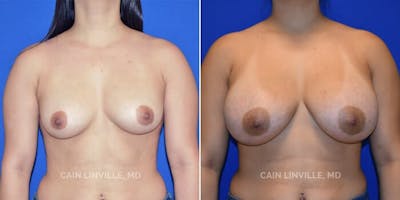 Breast Augmentation Before & After Gallery - Patient 8523059 - Image 1