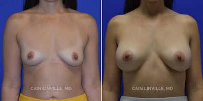 Breast Augmentation Before & After Gallery - Patient 8523078 - Image 1