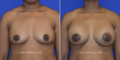 Breast Augmentation Before & After Gallery - Patient 8523105 - Image 1