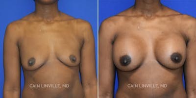 Breast Augmentation Before & After Gallery - Patient 8523126 - Image 1