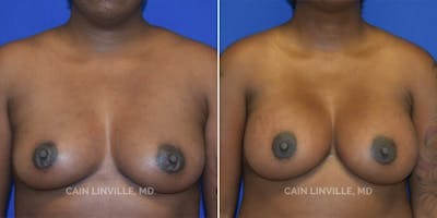 Breast Augmentation Before & After Gallery - Patient 8523145 - Image 1