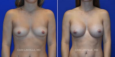 Breast Augmentation Before & After Gallery - Patient 8523161 - Image 1