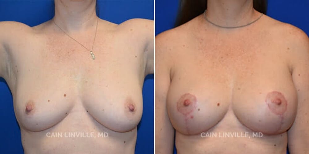 Breast Lift Before & After Gallery - Patient 8523288 - Image 1