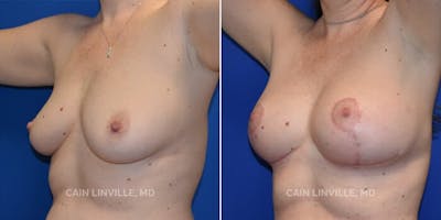 Breast Lift Before & After Gallery - Patient 8523288 - Image 2