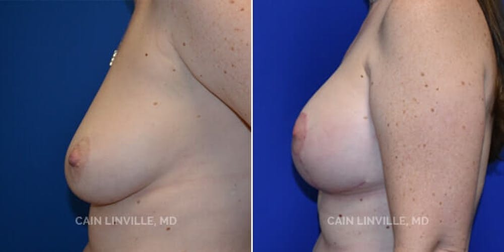 Breast Lift Before & After Gallery - Patient 8523288 - Image 3