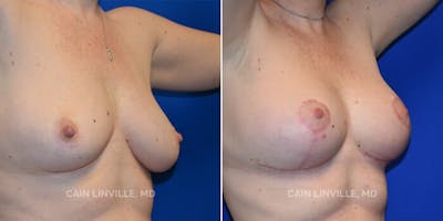 Breast Lift Before & After Gallery - Patient 8523288 - Image 4