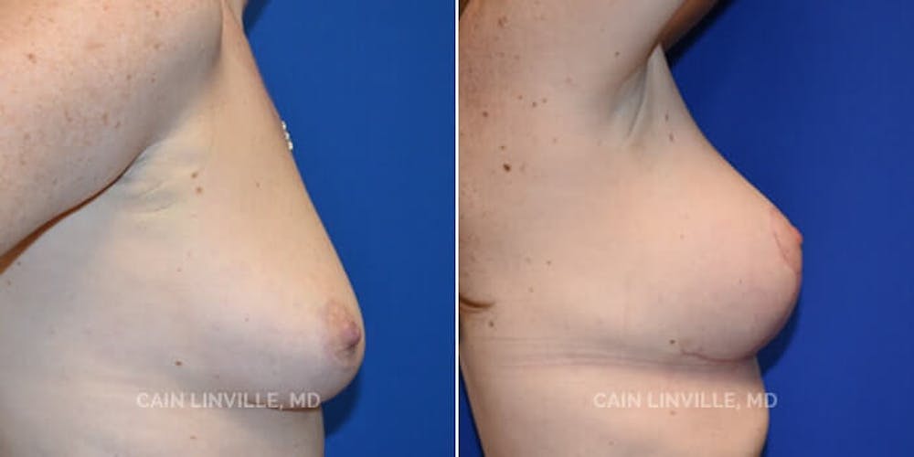 Breast Lift Before & After Gallery - Patient 8523288 - Image 5