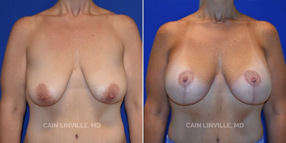 Breast Lift Before & After Gallery - Patient 8523308 - Image 1