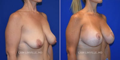 Breast Lift Before & After Gallery - Patient 8523308 - Image 2