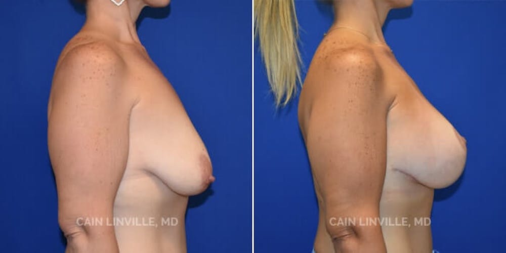 Breast Lift Before & After Gallery - Patient 8523308 - Image 3