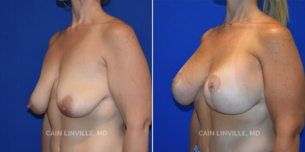 Breast Lift Before & After Gallery - Patient 8523308 - Image 4