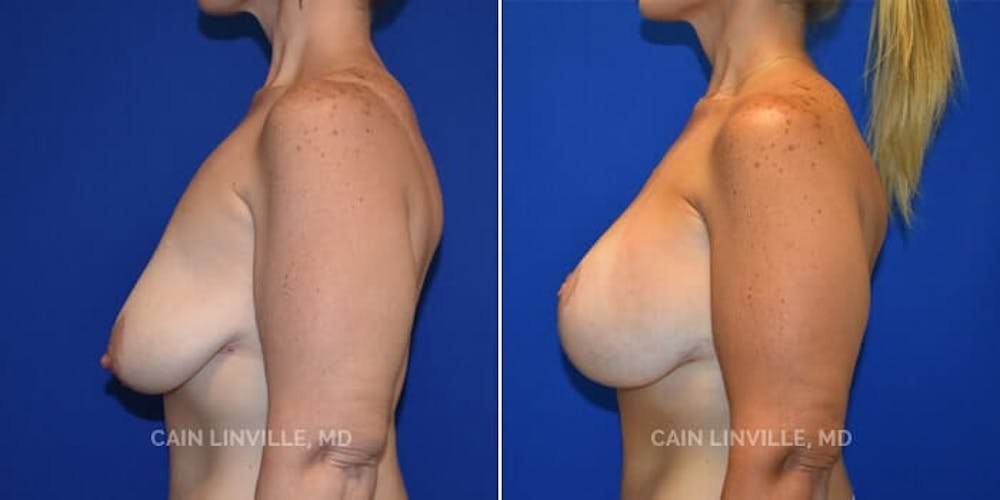 Breast Lift Before & After Gallery - Patient 8523308 - Image 5