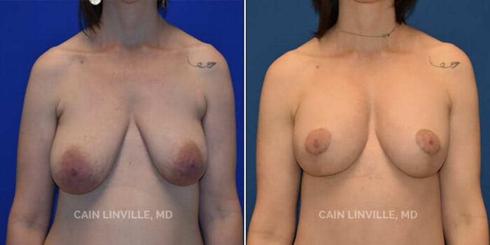 Breast Lift Before & After Gallery - Patient 8523320 - Image 1