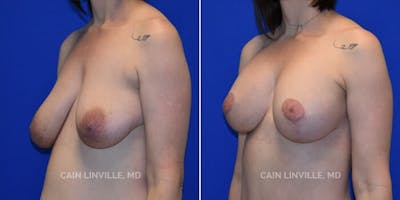 Breast Lift Before & After Gallery - Patient 8523320 - Image 2