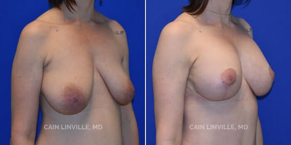 Breast Lift Before & After Gallery - Patient 8523320 - Image 3