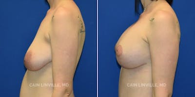 Breast Lift Before & After Gallery - Patient 8523320 - Image 4