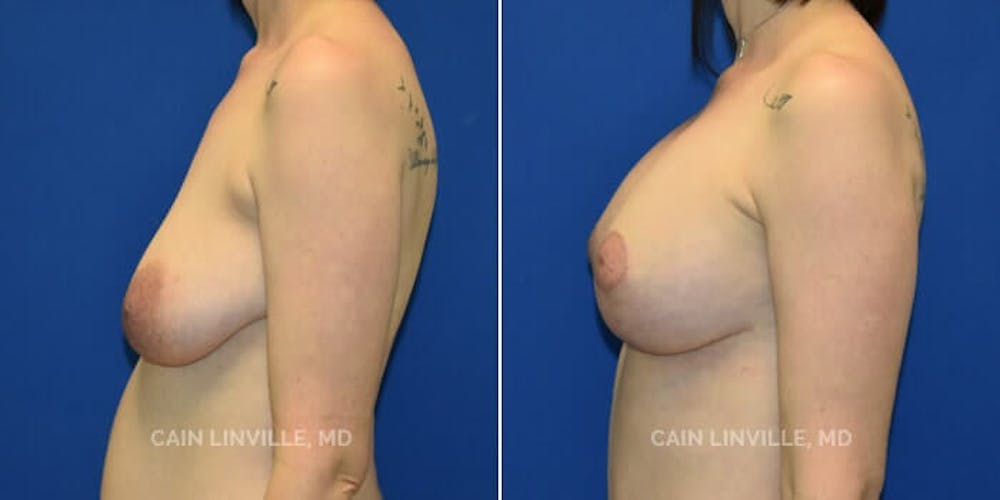 Breast Lift Before & After Gallery - Patient 8523320 - Image 4