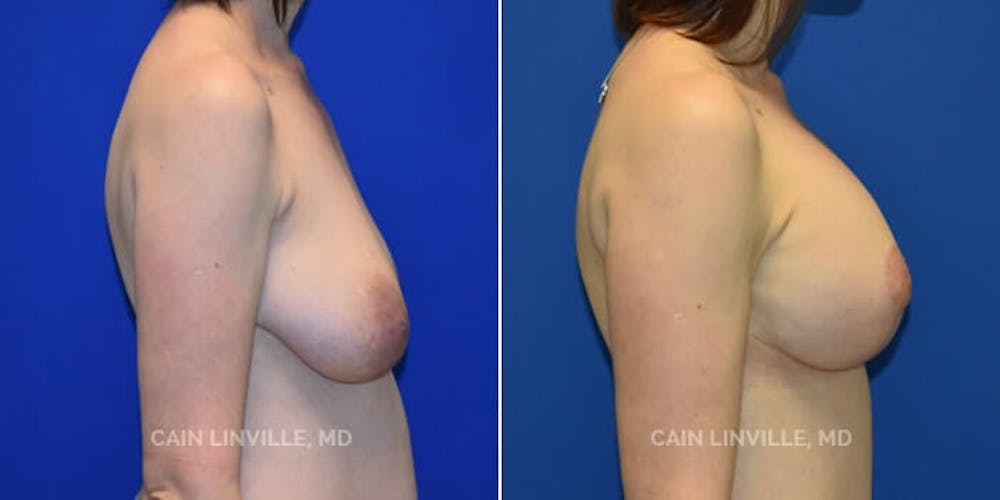 Breast Lift Before & After Gallery - Patient 8523320 - Image 5