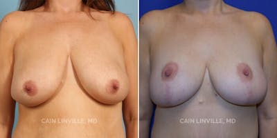 Breast Reduction Before & After Gallery - Patient 8523337 - Image 1