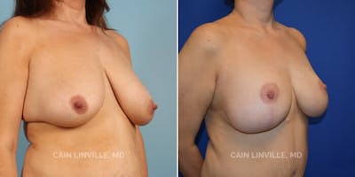 Breast Reduction Before & After Gallery - Patient 8523337 - Image 2