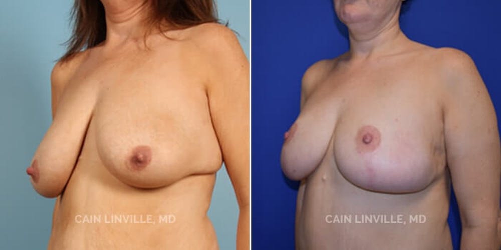 Breast Reduction Before & After Gallery - Patient 8523337 - Image 3