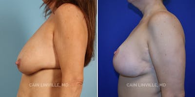 Breast Reduction Before & After Gallery - Patient 8523337 - Image 4