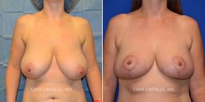 Breast Reduction Before & After Gallery - Patient 8523357 - Image 1