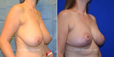 Breast Reduction Before & After Gallery - Patient 8523357 - Image 2