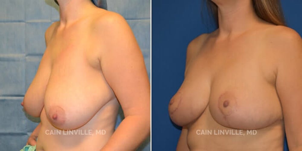 Breast Reduction Before & After Gallery - Patient 8523357 - Image 4