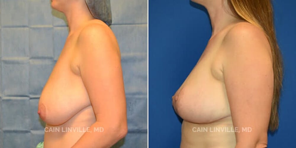Breast Reduction Before & After Gallery - Patient 8523357 - Image 5