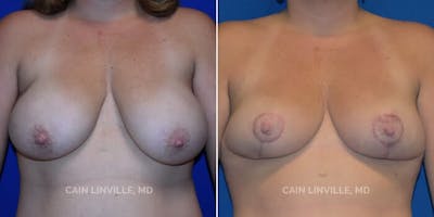 Breast Reduction Before & After Gallery - Patient 8523367 - Image 1