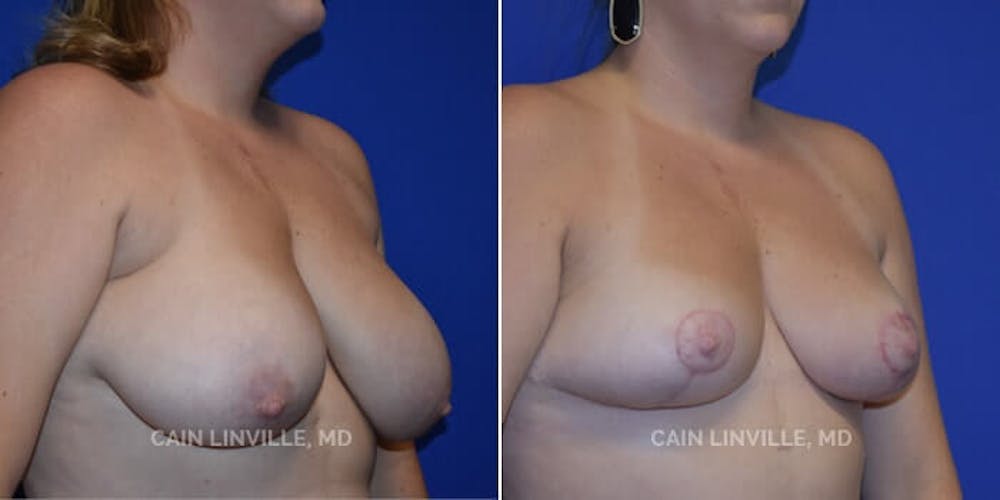 Breast Reduction Before & After Gallery - Patient 8523367 - Image 2