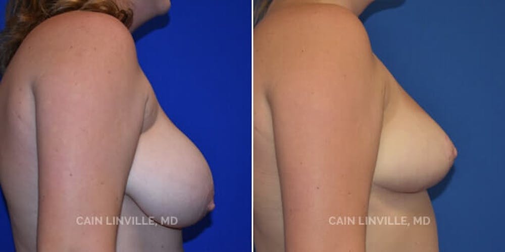 Breast Reduction Before & After Gallery - Patient 8523367 - Image 3
