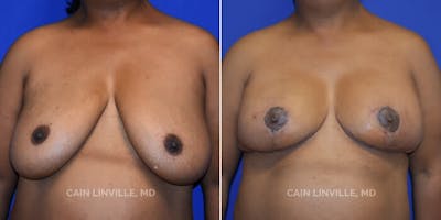 Breast Reduction Before & After Gallery - Patient 8523385 - Image 1