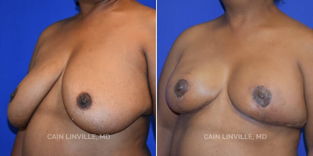 Breast Reduction Before & After Gallery - Patient 8523385 - Image 2