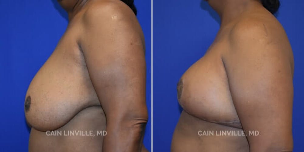 Breast Reduction Before & After Gallery - Patient 8523385 - Image 3