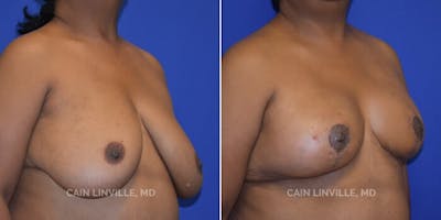 Breast Reduction Before & After Gallery - Patient 8523385 - Image 4