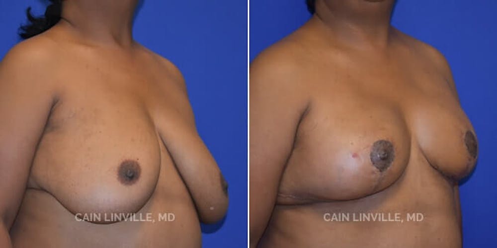 Breast Reduction Before & After Gallery - Patient 8523385 - Image 4