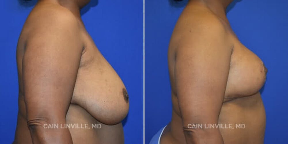 Breast Reduction Before & After Gallery - Patient 8523385 - Image 5