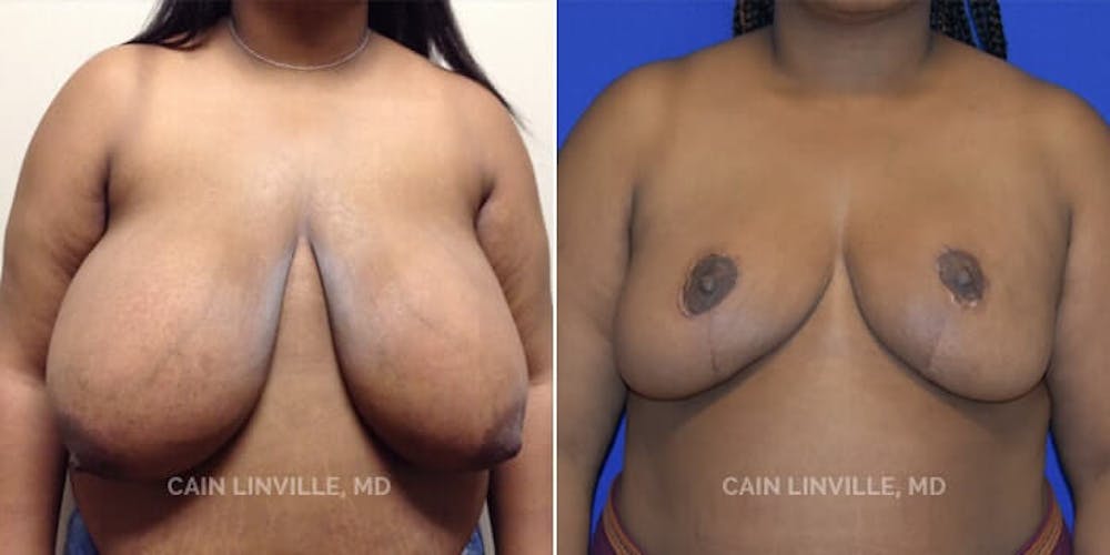Breast Reduction Before & After Gallery - Patient 8523397 - Image 1