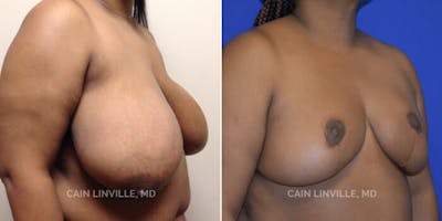 Breast Reduction Before & After Gallery - Patient 8523397 - Image 2