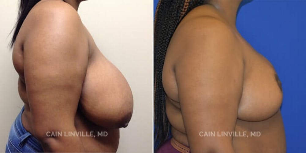 Breast Reduction Before & After Gallery - Patient 8523397 - Image 3