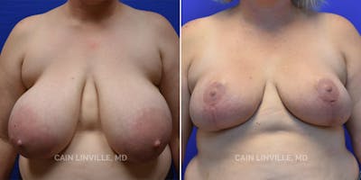 Breast Reduction Before & After Gallery - Patient 8523406 - Image 1