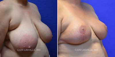 Breast Reduction Before & After Gallery - Patient 8523406 - Image 2