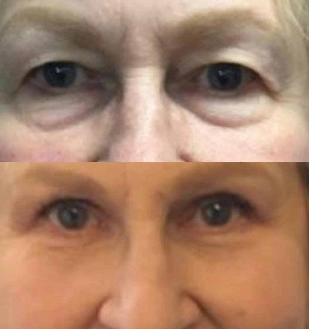 Lower Blepharoplasty Before & After Gallery - Patient 8523432 - Image 1