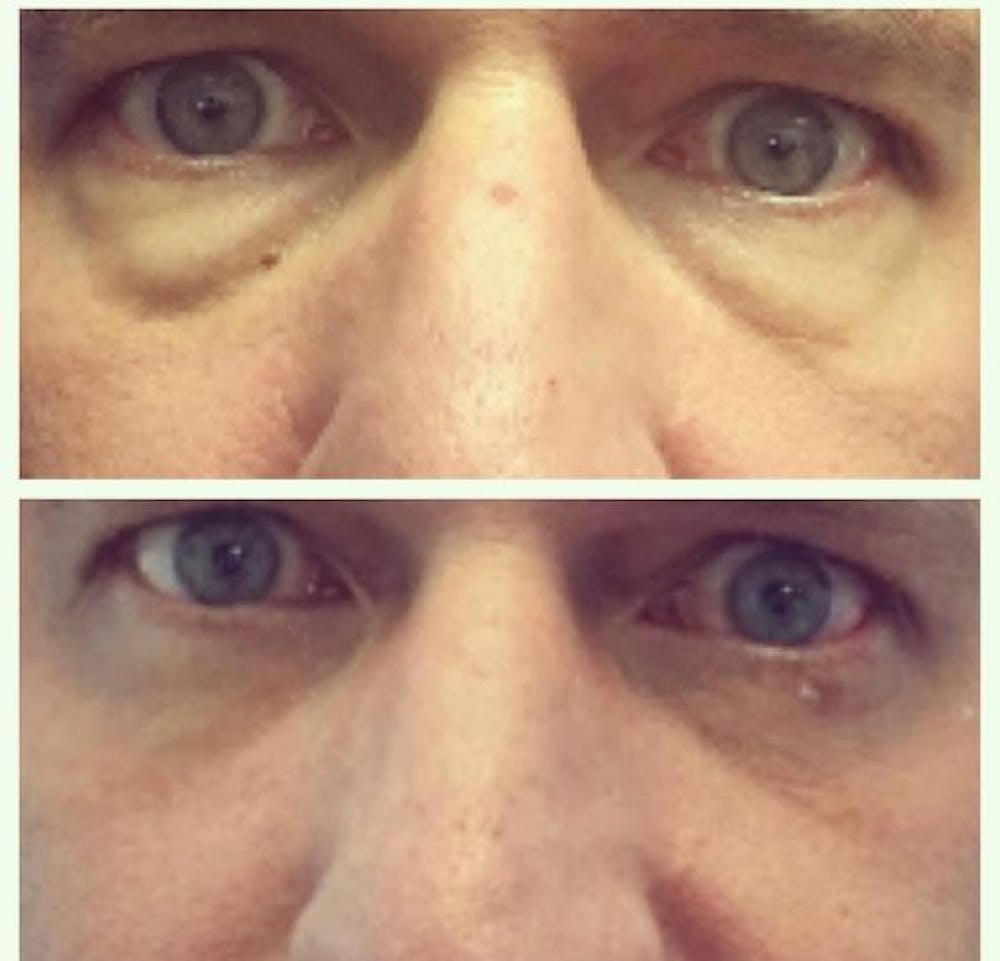 Lower Blepharoplasty Before & After Gallery - Patient 8523443 - Image 1