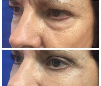 Lower Blepharoplasty Before & After Gallery - Patient 8523447 - Image 1
